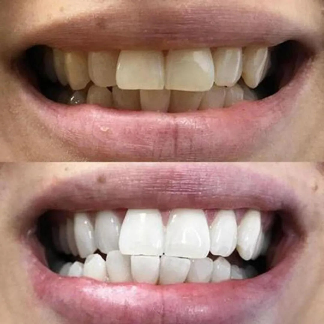 WhiteFlash™ – Des Dents Plus Blanches en 14 Jours