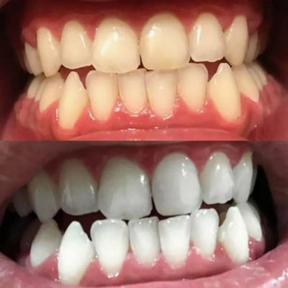 WhiteFlash™ – Des Dents Plus Blanches en 14 Jours