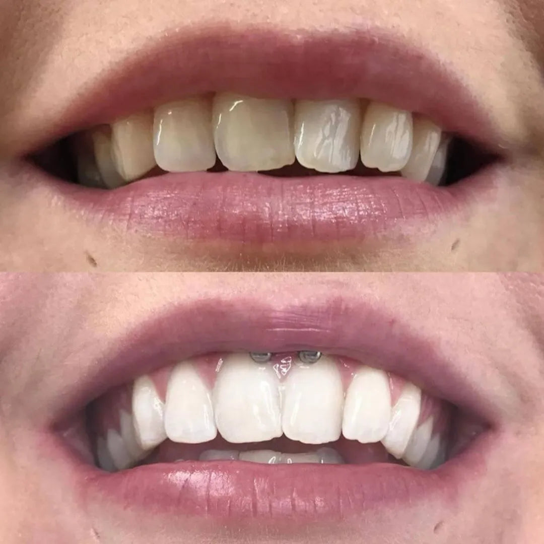 WhiteFlash™ – Des Dents Plus Blanches en 14 Jours
