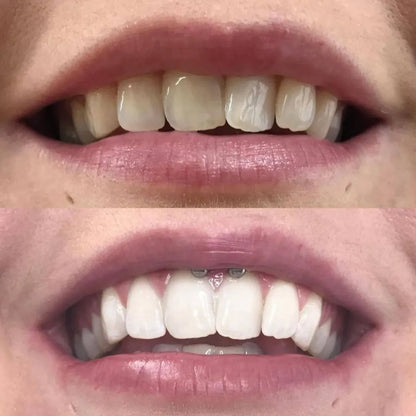 WhiteFlash™ – Des Dents Plus Blanches en 14 Jours