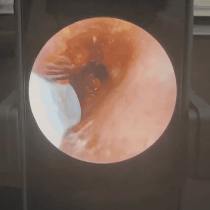 OryaneCam™ – Nettoyeur d’oreilles intelligent avec caméra HD